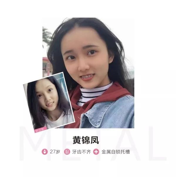 别人矫牙1万起,广州只要3960元!仅限2天