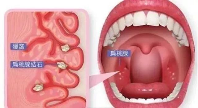 秒除口臭,一秒解决当天口臭