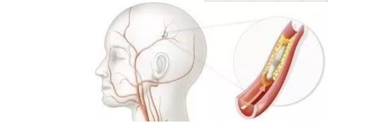 中国神经干细胞治疗中风临床试验,中国干细胞治疗脑中风突破性进展