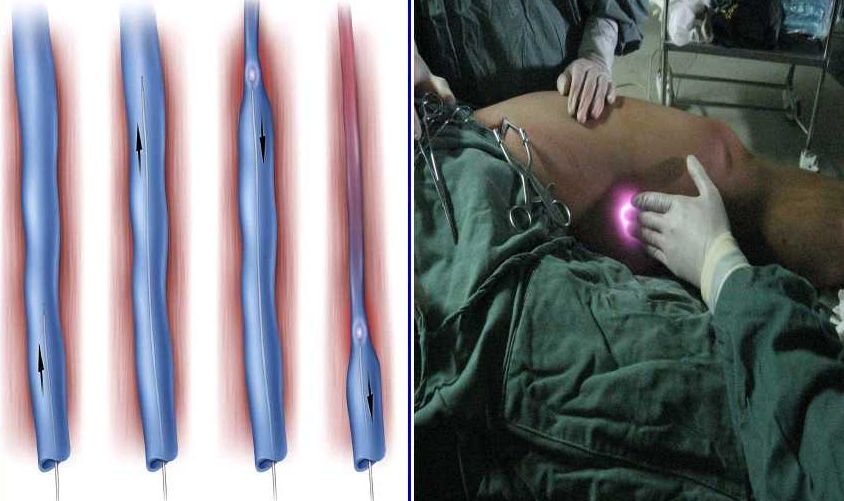 筋疙瘩的图片大全,筋疙瘩的危害