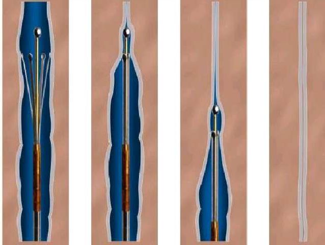 筋疙瘩的图片大全,筋疙瘩的危害