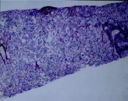妊娠期急性脂肪肝的症状有哪些,妊娠期急性脂肪肝是什么引起的