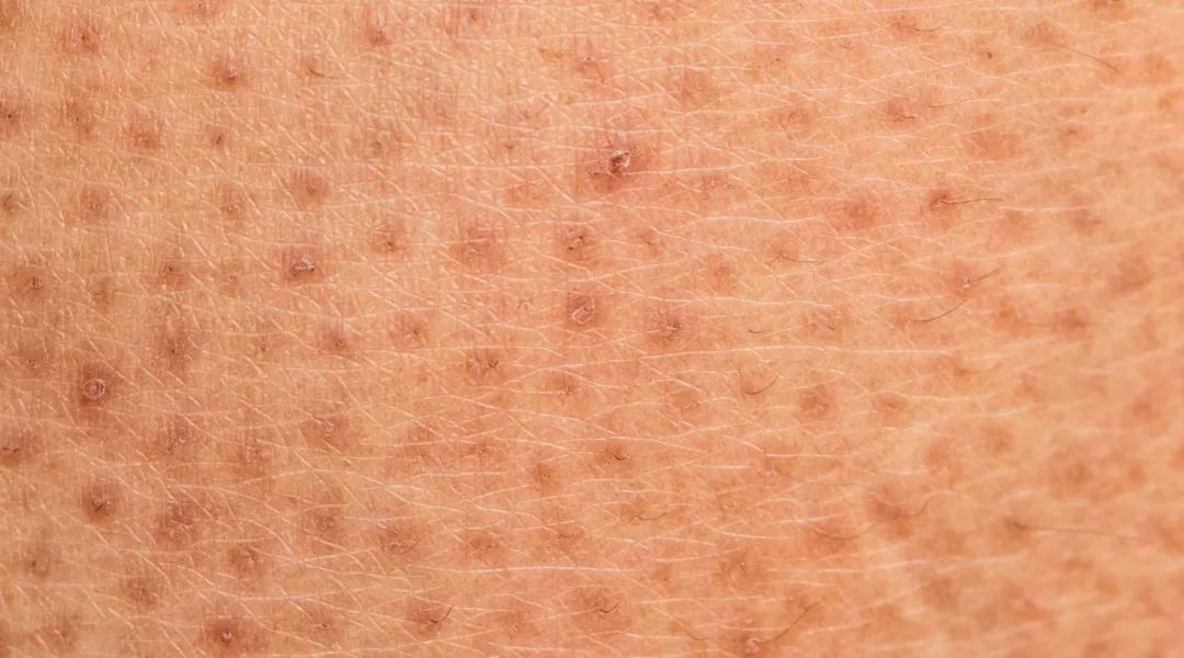 皮肤干燥起皮的救星,皮肤干燥起皮怎么办用什么护肤品