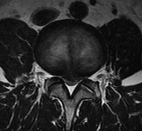一分钟带你了解腰椎狭窄,椎管狭窄症知识大全