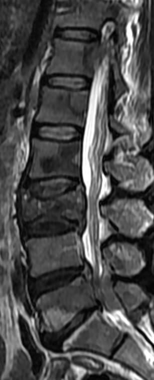 一分钟带你了解腰椎狭窄,椎管狭窄症知识大全