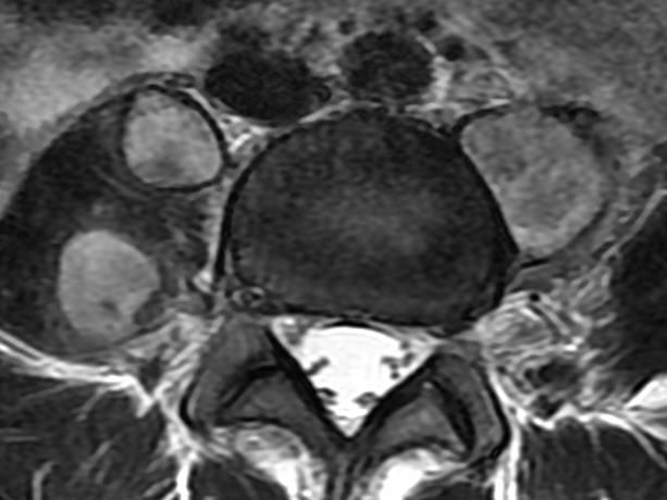 一分钟带你了解腰椎狭窄,椎管狭窄症知识大全
