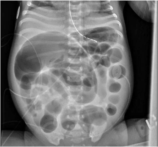 腹胀便秘恶心呕吐是什么病,腹胀腹痛反酸便秘