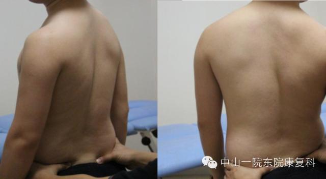 筋膜的康复训练方法,12条筋膜链解析及治疗手法