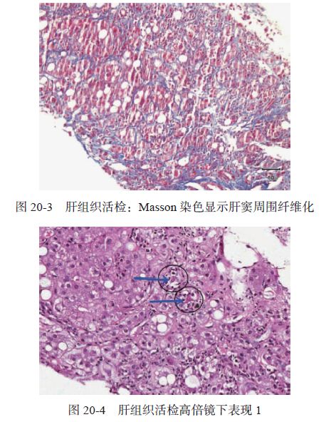 Zieve综合征1例|肝脏疾病疑难与经典病例(第四辑)