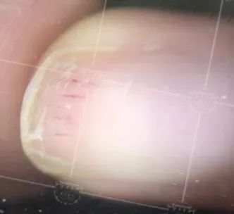 灰指甲致癌吗,灰指甲美甲的禁忌