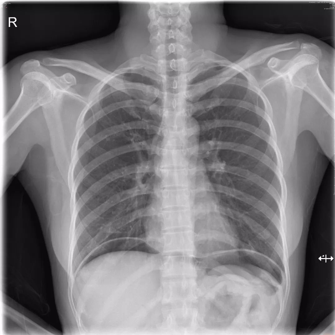 急诊科常见急腹症观察,腹部急诊影像大全值得收藏