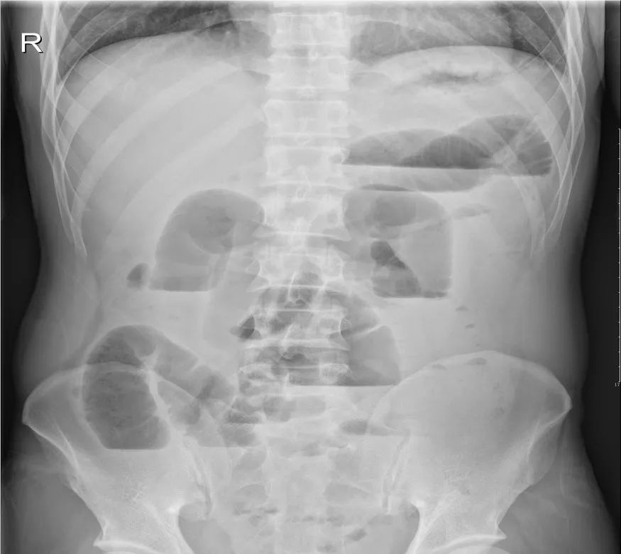 急诊科常见急腹症观察,腹部急诊影像大全值得收藏