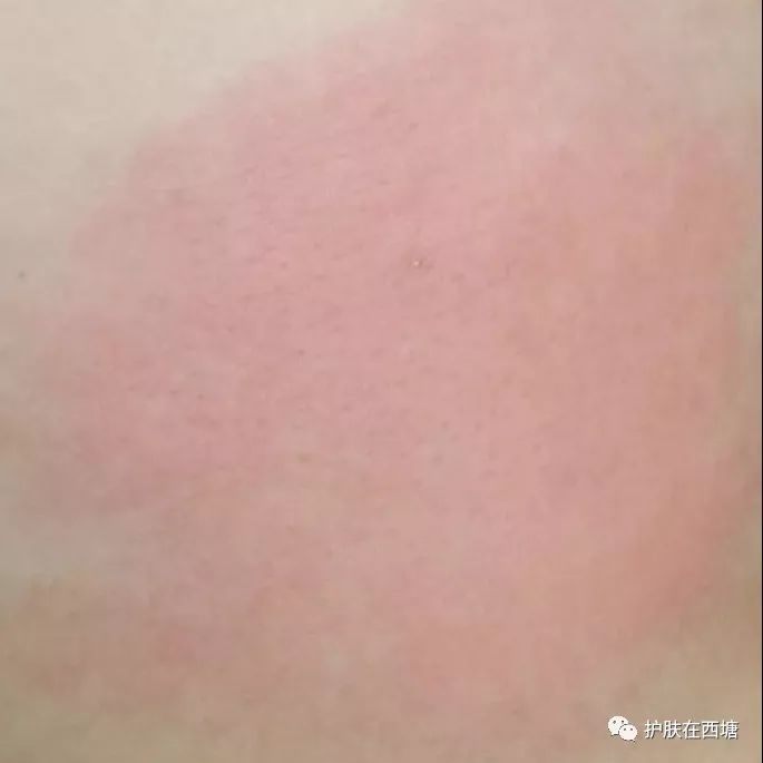 水过敏会引起荨麻疹吗,水过敏皮肤