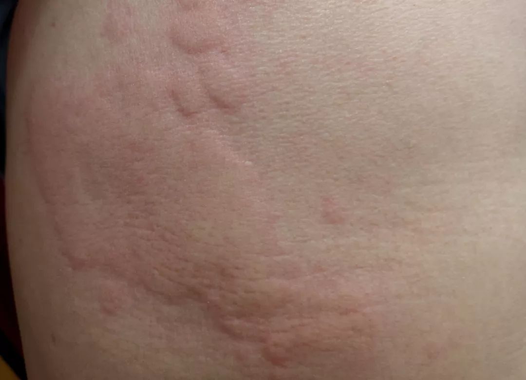 水过敏会引起荨麻疹吗,水过敏皮肤