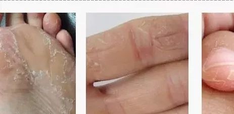 治脚气干裂起皮用什么药膏,有这个方子来治脚气就不怕复发