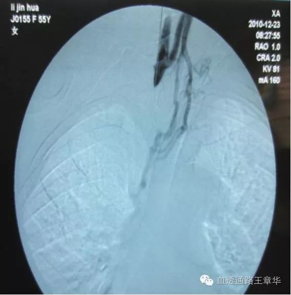 自体动静脉内瘘术后护理,自体动静脉内瘘术后2周锻炼方法