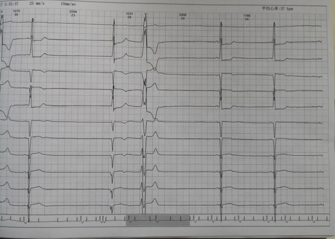 缺血性心脏病吃哪些中成药,心肌缺血合并心衰吃什么恢复得快