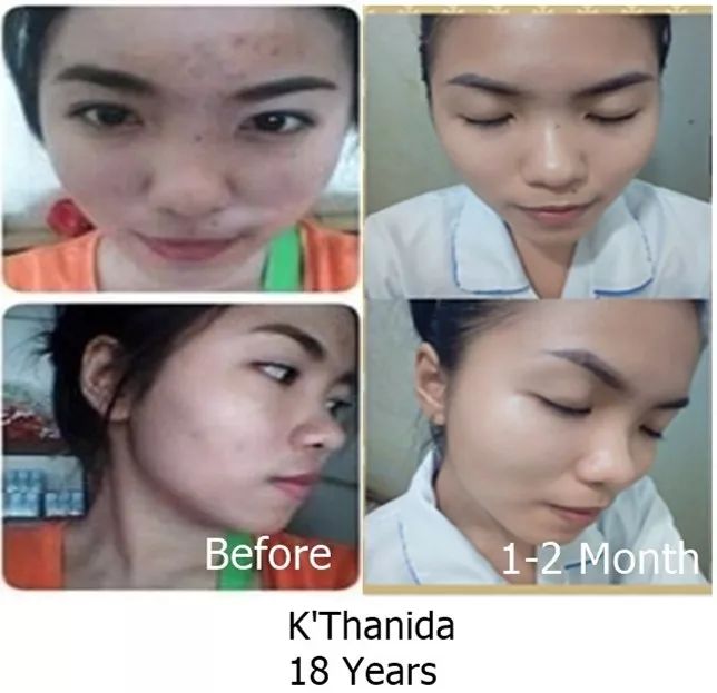 1分钱祛痘神器,祛痘神器0元领取