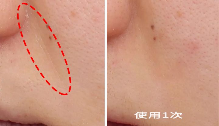 三十岁就有眉间纹法令纹怎么办,30岁法令纹眉心纹深