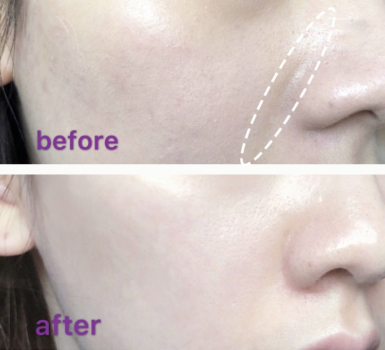 三十岁就有眉间纹法令纹怎么办,30岁法令纹眉心纹深