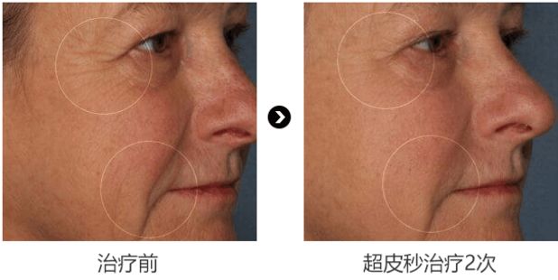 ‘斑’弄是非，超皮秒要你好看