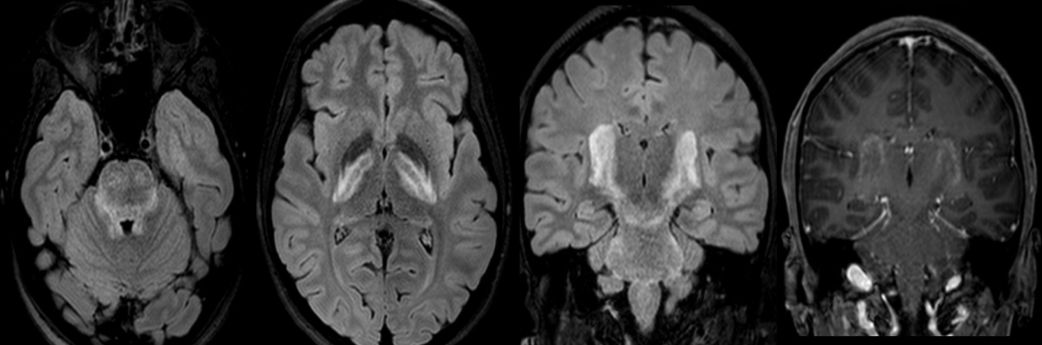 急性脂肪栓塞、神经白塞病、NMOSD极后区综合征丨3分钟读片·第11期