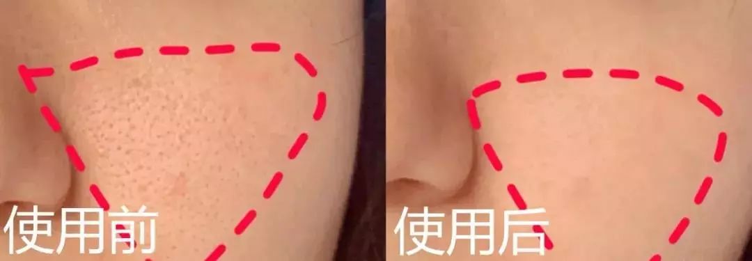 痘痘闭口里面有油脂,鼻子上的痘痘是青春痘还是粉刺