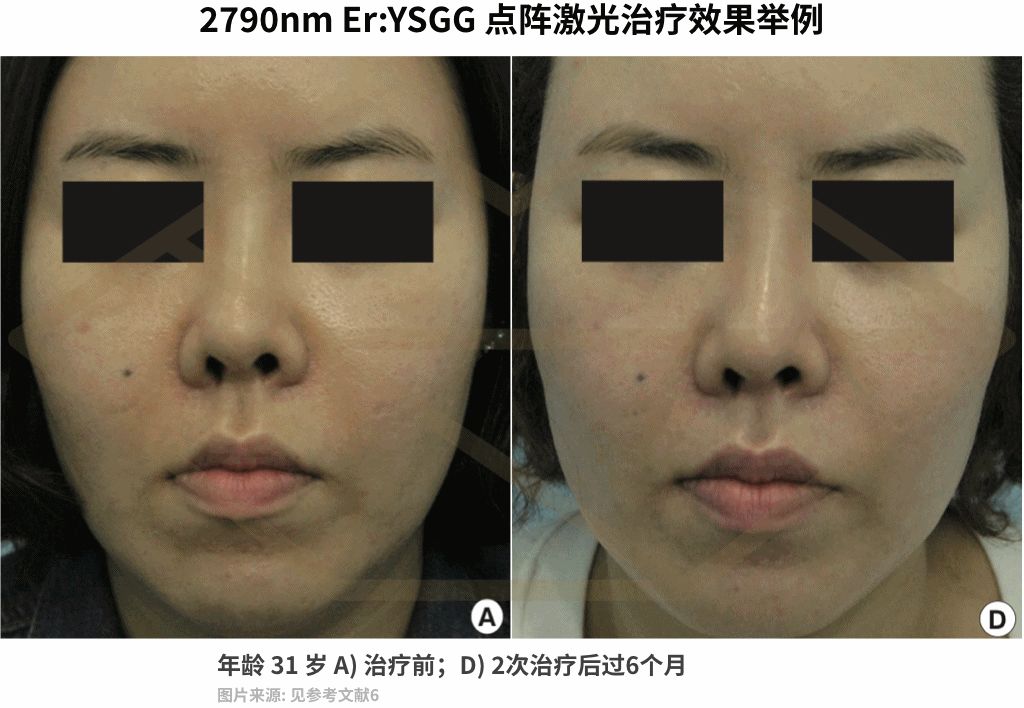 十几年的痘坑毛孔粗大,毛孔粗大不可逆别慌还有救