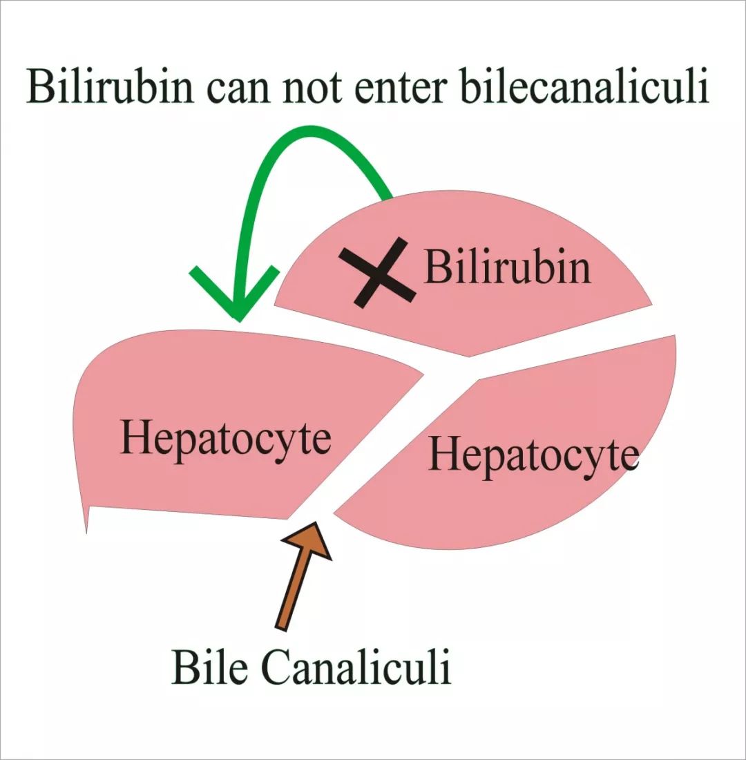 如何治疗先天性胆红素血症,先天性高胆红素血症需要治疗吗