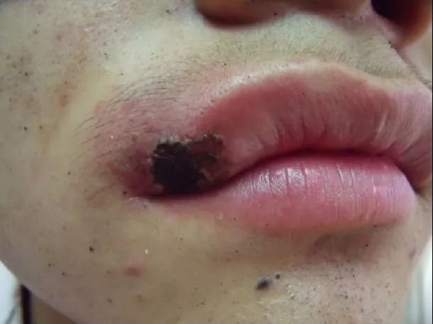 不要再撕嘴唇死皮了,很可能撕出这种病,会血流不止...