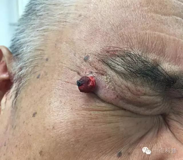 不要再撕嘴唇死皮了,很可能撕出这种病,会血流不止...