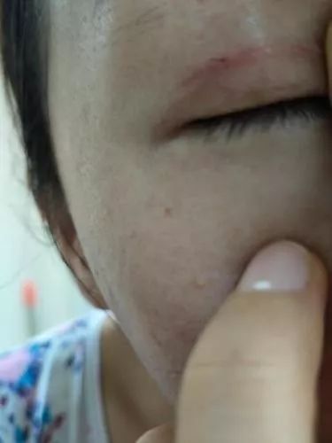 女子整形割双眼皮,女子整容后惨不忍睹