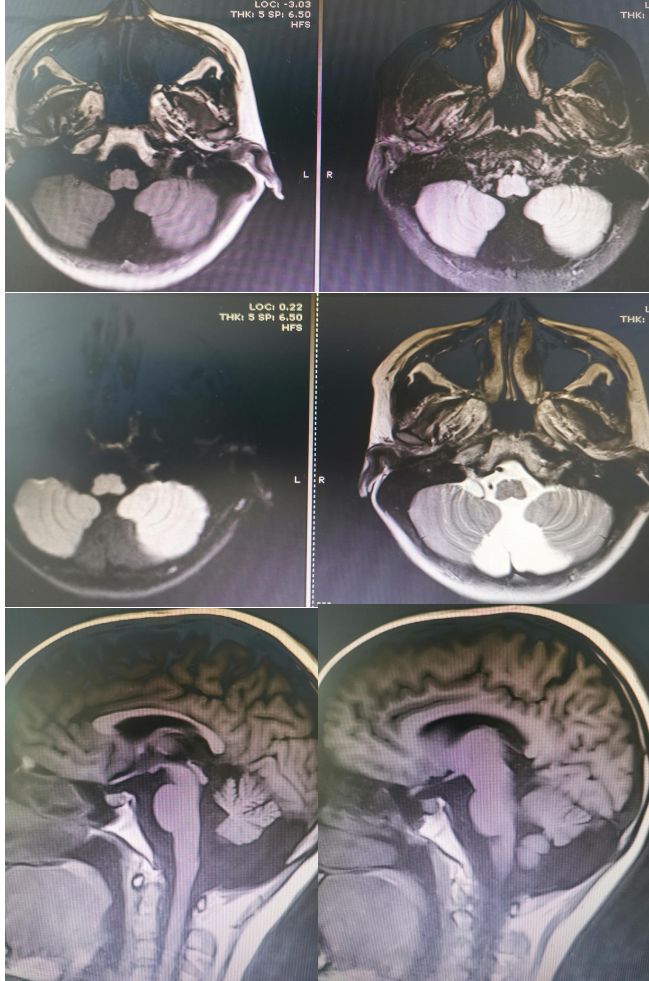 Rasmussen脑炎、结核性肉芽肿、脑发育性静脉畸形丨3分钟读片·第13期,下)