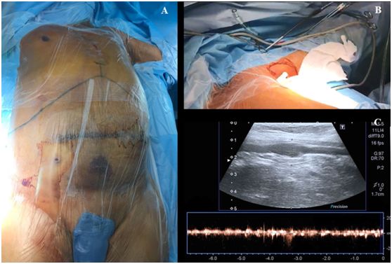 超声引导下腋静脉穿刺置管视频,超声引导腋静脉穿刺视频教程