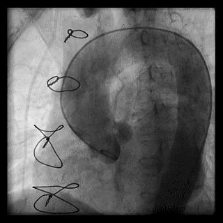 冠脉造影技术成熟不,跟我学技术分析从入门到精通