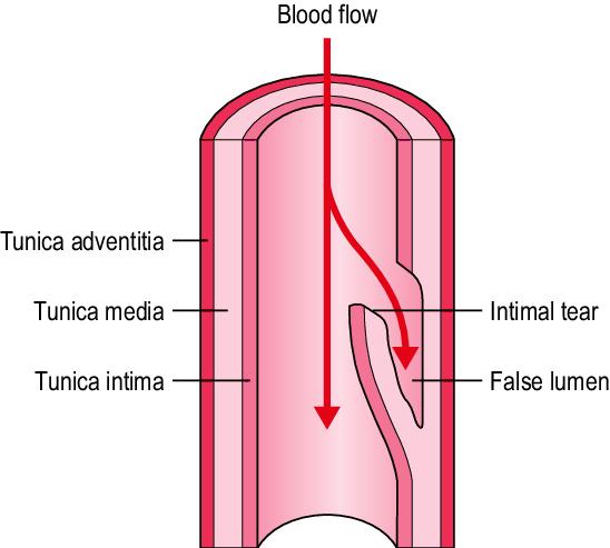 夜读：动脉的夹层，就仿佛是人生的夹缝