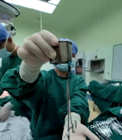 3岁女童患怪病肚子大如球,7岁女童突然腹痛元凶竟是畸胎瘤