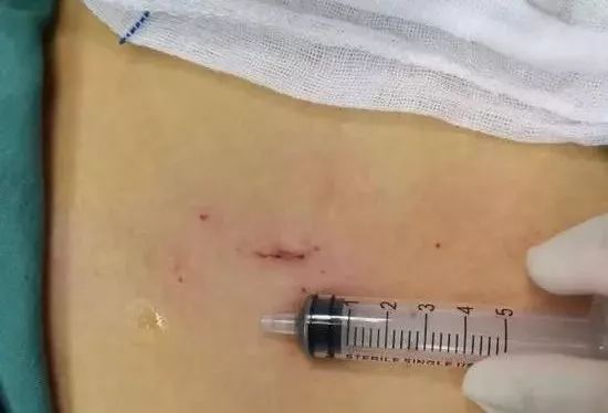 看着就疼!11岁男孩觉得要害部位不适,竟取出一根草