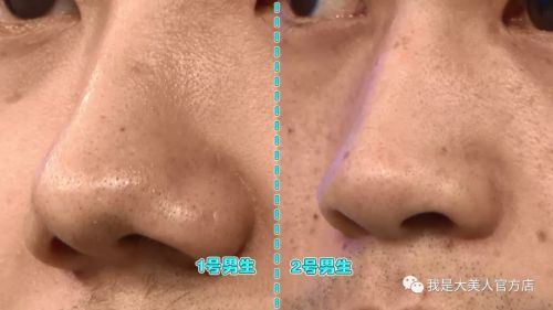 画面极度舒适！十几年顽固老黑头，30秒彻底连根拔起！毛孔畅快呼吸原来是这种感觉