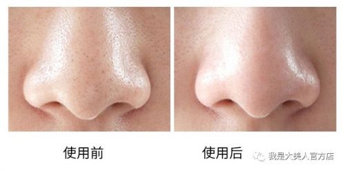 画面极度舒适！十几年顽固老黑头，30秒彻底连根拔起！毛孔畅快呼吸原来是这种感觉