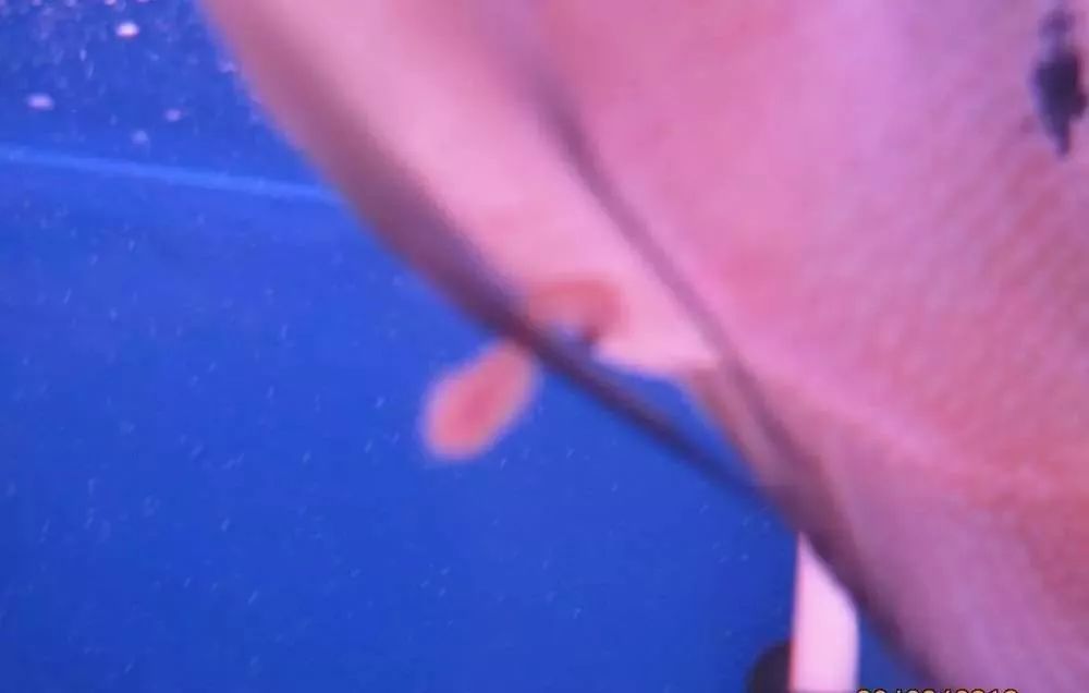 慢性肠炎用中医还是西医治疗好,肠炎食疗最简单方法