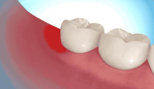 拔智齿的全过程科普,拔智齿细致操作过程