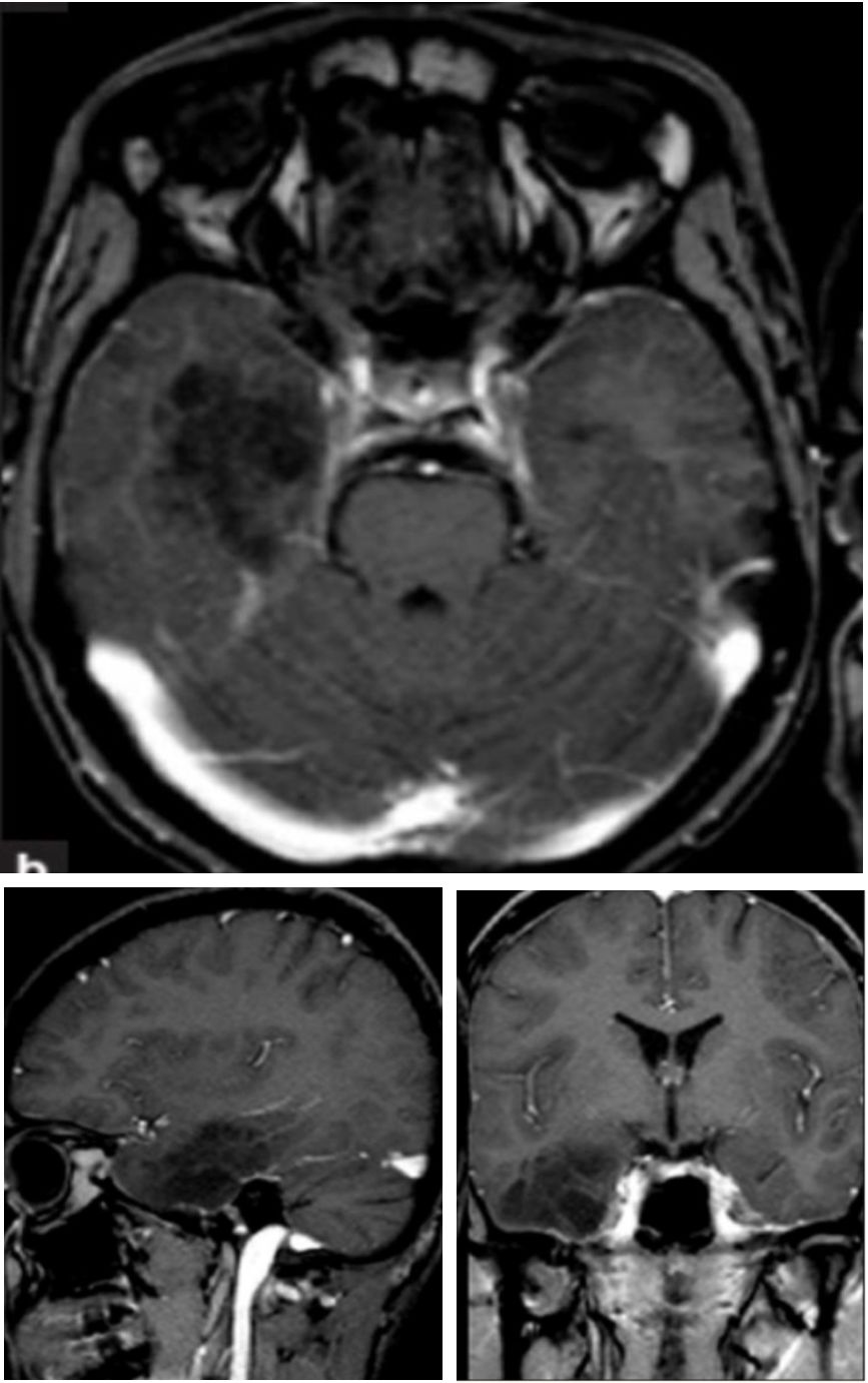 Whipple病、纹状体手、神经结节病、脱髓鞘假瘤丨3分钟读片·第16期