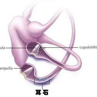 耳石症复位疗法视频,耳石症复位后的十大注意事项