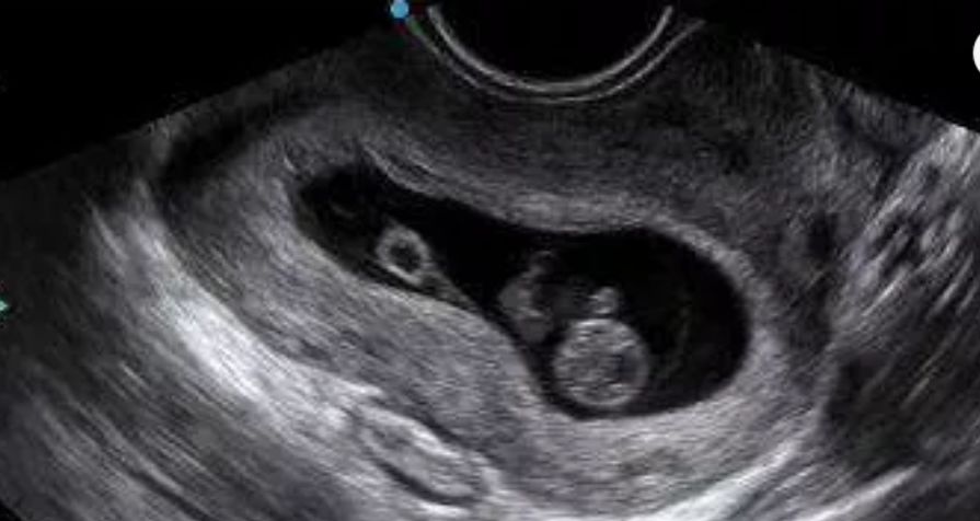 早孕期做b超有辐射吗,胎儿16周早筛超声检查