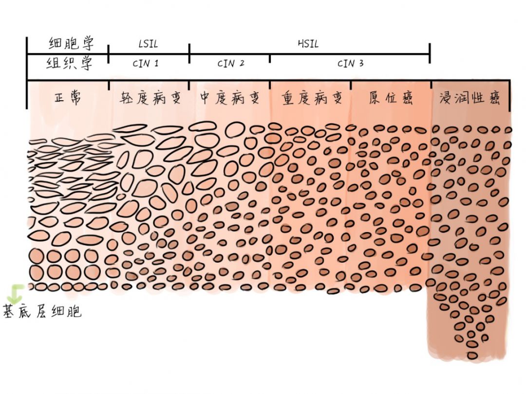 从hpv感染发展到宫颈癌要几个阶段,hpv感染到宫颈癌的真实经历