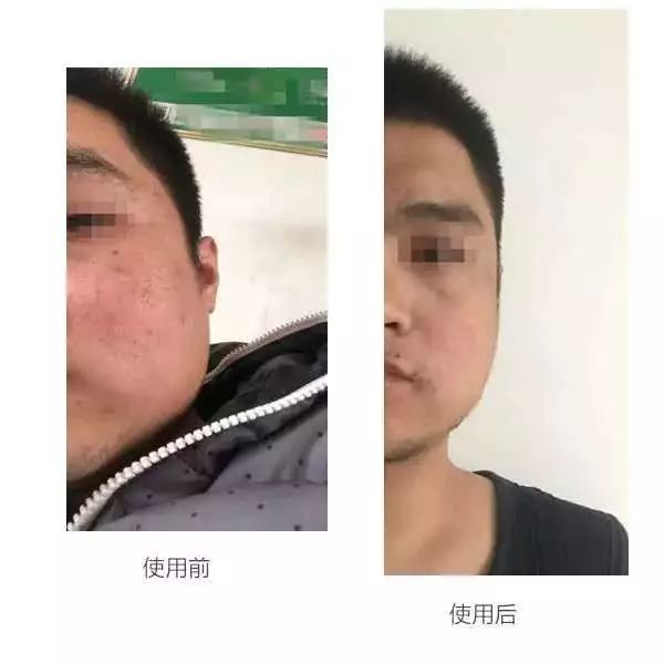 哪个牌子的壬二酸凝胶好,首博尔壬二酸清痘凝胶副作用