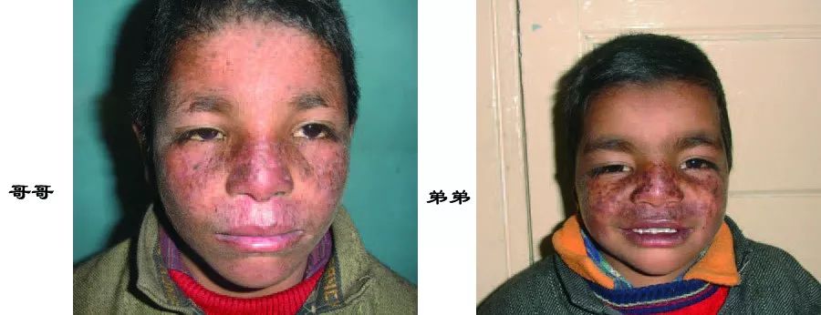 面部蝶形红斑一定是红斑狼疮吗,面颈部环状红斑是什么原因引起的