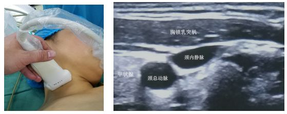 围术期中心静脉监测的专家共识（2017版）