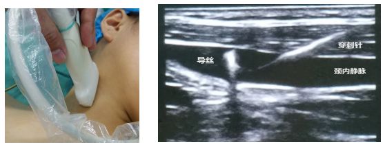 围术期中心静脉监测的专家共识（2017版）